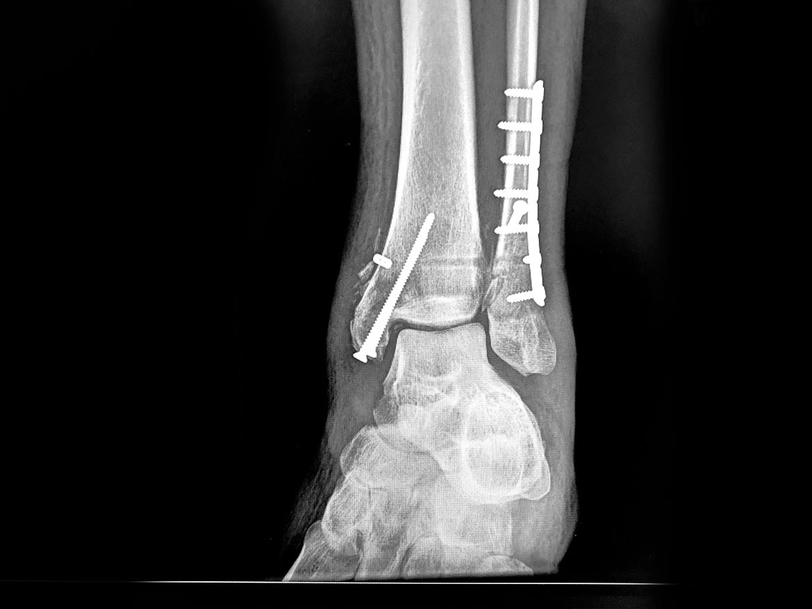 X-ray image of a fractured ankle and ankle socket taken after surgery following a backpacking accident in the Indian Heaven Wilderness, Washington. The metal screws and surgical hardware securing the bone are clearly visible, highlighting both the severity of the injury and the medical intervention required for stabilization.