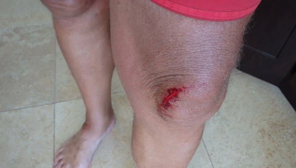 Bakers Bay Injury